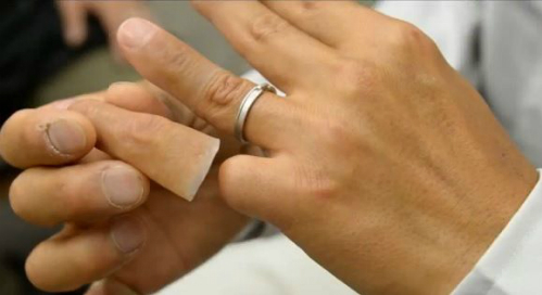 Cụt ngón tay - Hình ảnh minh họa